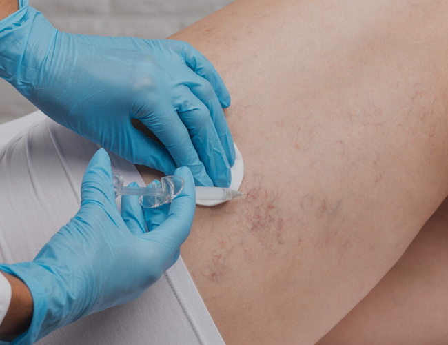 Sclerotherapy